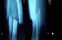 Röntgenbild eines gebrochenen Knochens